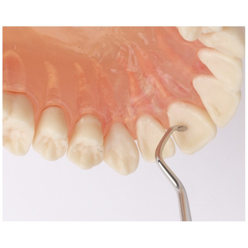 Anterior Lingual Stain Remover (lingual/palatinal), Nr. SCALSR