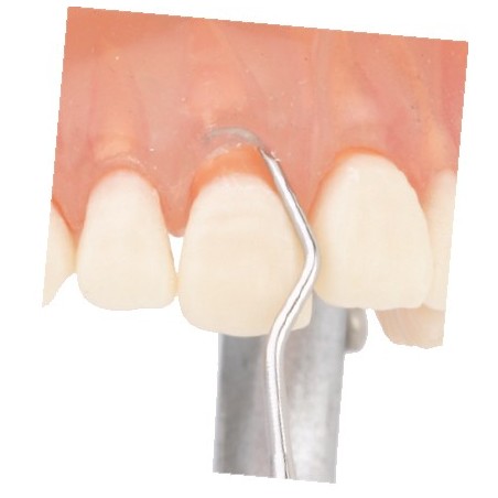 Scalette, Anterior, N137 kurzes Arbeitsende, Nr. SCN137M