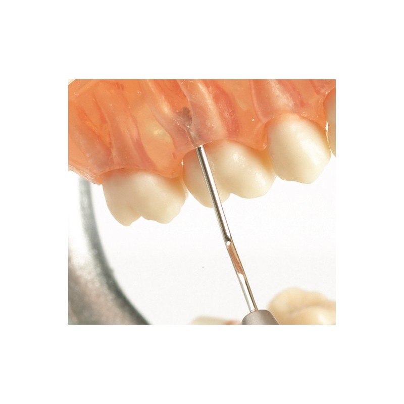 konkav - konvex, Nr. DF2 (mesial-distal)